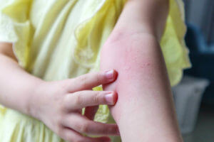 contact allergy on a child's arm