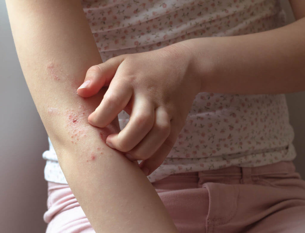 A child scratching an eczema