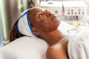 young woman with acne scars on face lying on bed for treatment