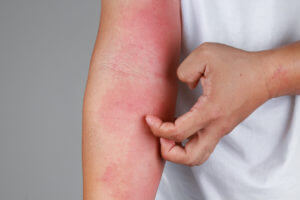 Eczema allergy skin