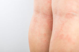young child with eczema behind his legs