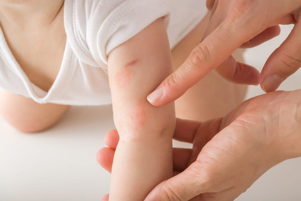 Baby Eczema - Happy Skin Pediatric Dermatology - Phoenix AZ