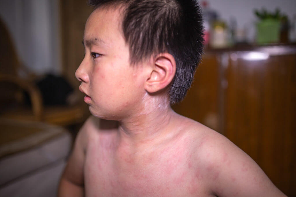 Image of boy suffering with eczema