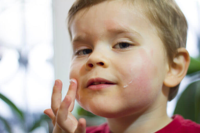 little boy applying cream for his eczema flare up