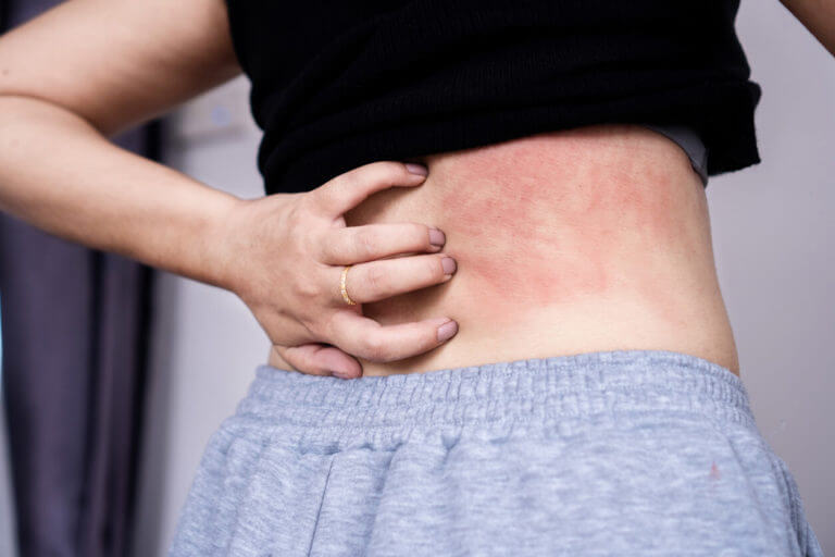 Woman suffering from a skin condition similar to atopic dermatitis, scratching her itchy back with her hand.