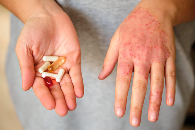 A woman with supplements for treating eczema due to atopic dermatitis.