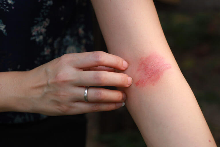 Image of a white woman's arm showing eczema and atopic dermatitis.