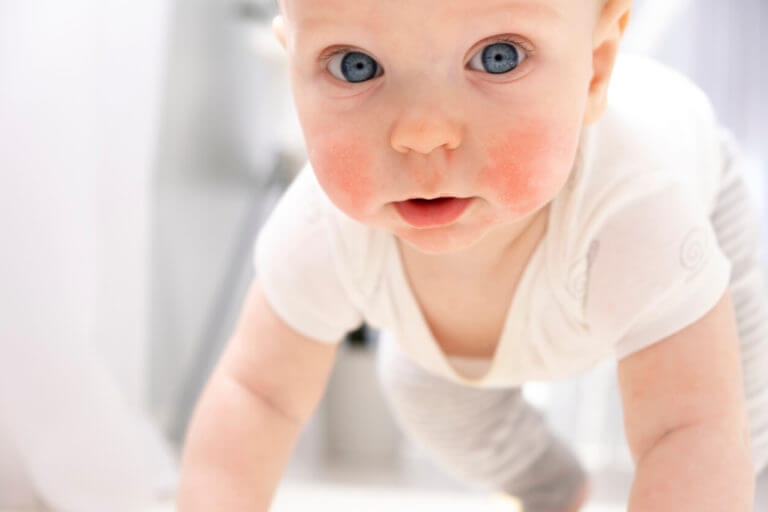 Image of a baby with atopic dermatitis.