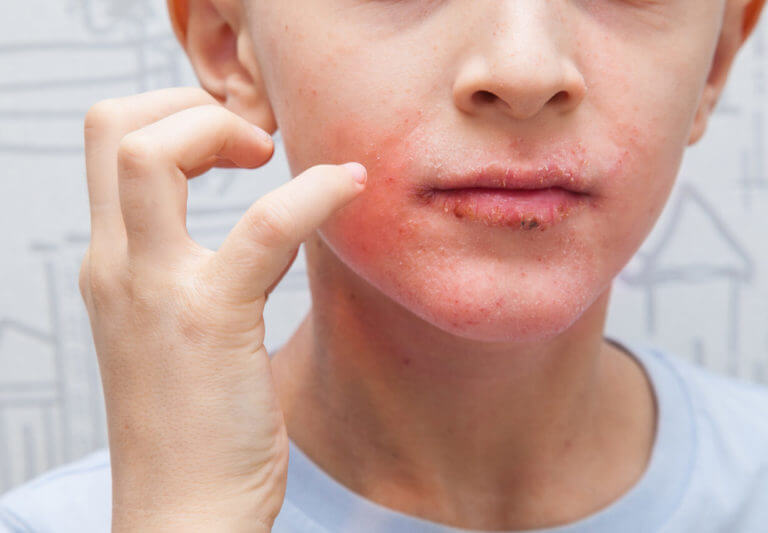 A boy is scratching his face due to an allergic reaction, showing a rash on his face and lips caused by eczema.