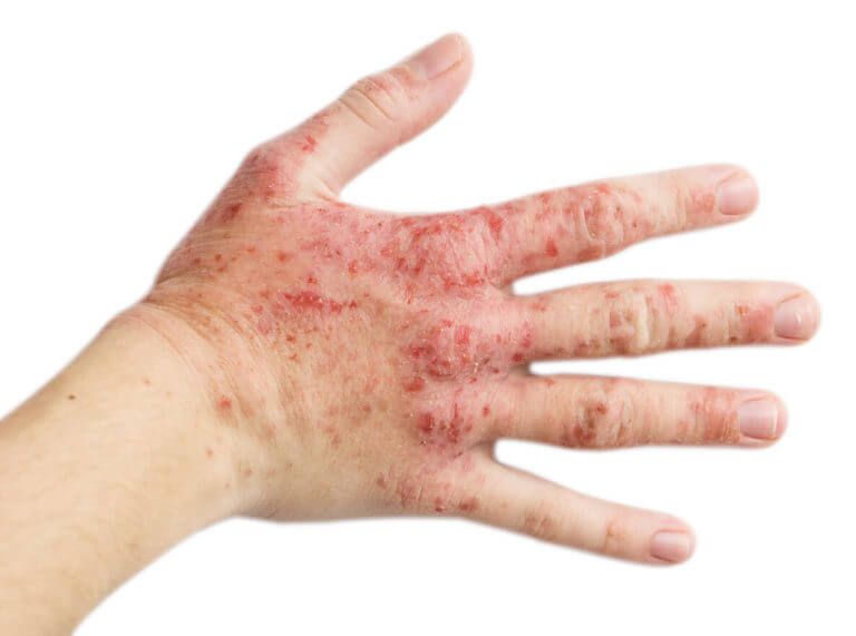 A right hand of a woman with eczema on it, also known as hand dermatitis.