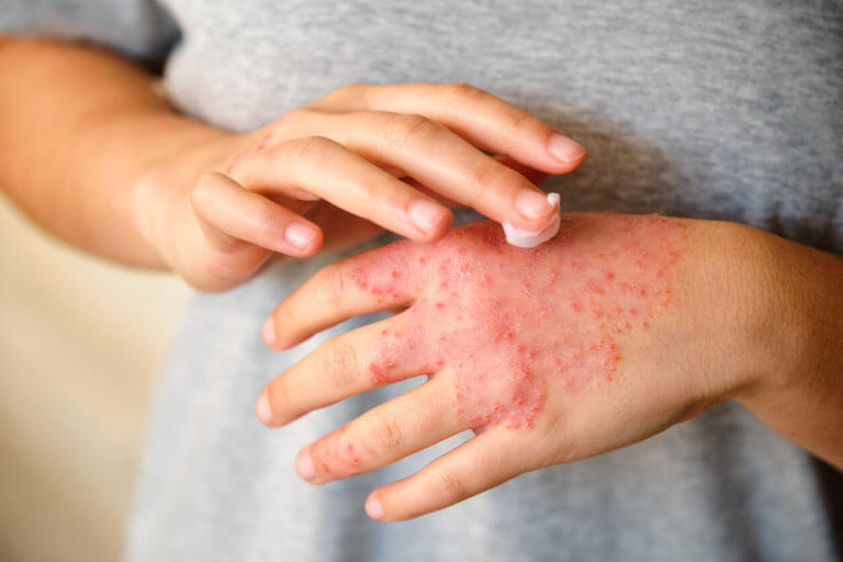 A woman is applying ointment or moisturizing cream to treat her eczema and atopic dermatitis.