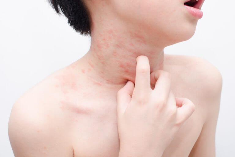 A child skin with eczema rash.