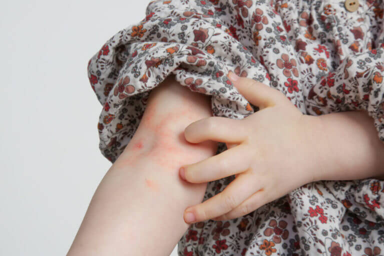 A toddler girl suffering from atopic dermatitis with red, itchy skin.