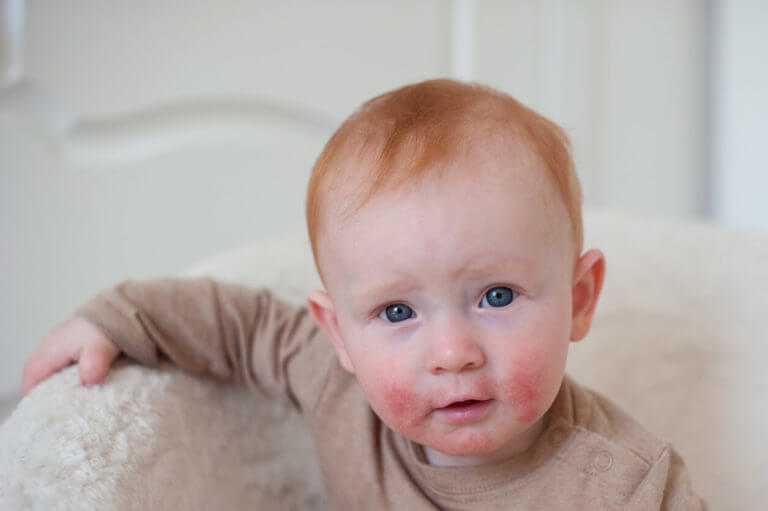 Image of a baby with atopic dermatitis, also known as Eczema.