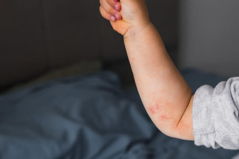 A small hand of child covered by eczema.