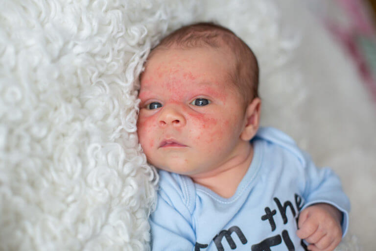 Little newborn baby with skin rash caused by eczema.