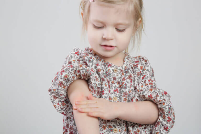 Toddler girl with atopic dermatitis, causing red, itchy skin and eczema on her arm.