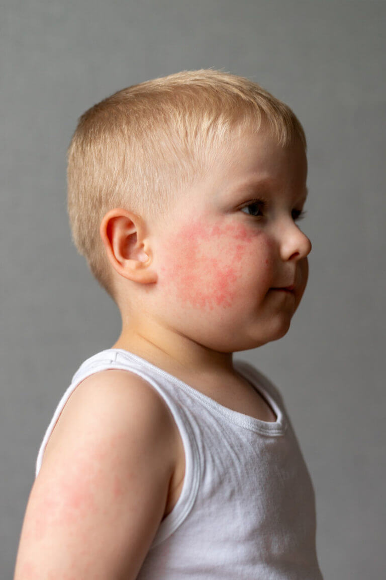 Child in white shirts with rash on face and arms caused by childhood eczema.