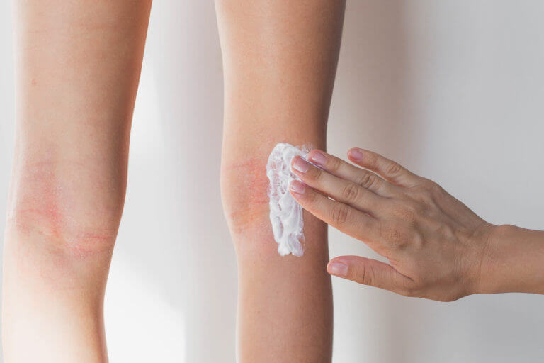 Mother smears her 7 year old daughter's red skin under the knees with a special moisturizing cream for atopic skin, to treat child’s eczema.