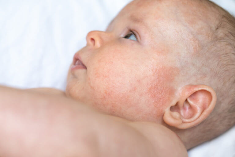A baby boy face with red irritated skin on left cheek, due to atopic dermatitis.