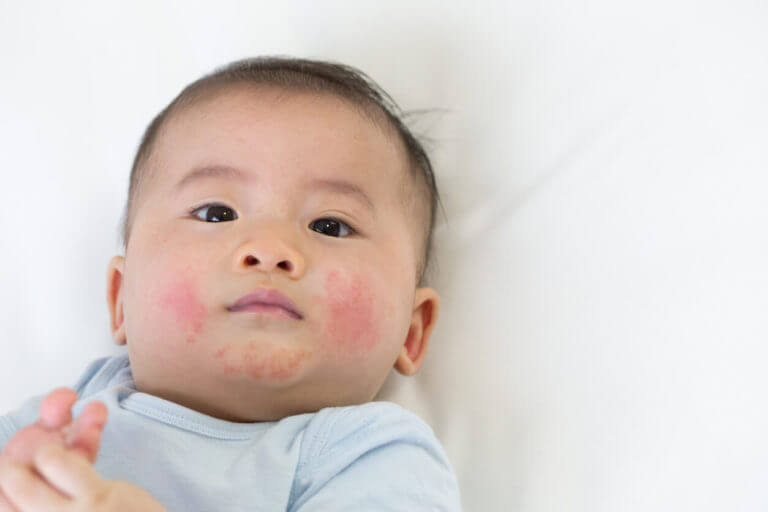 Skin rashes in babies due to eczema.