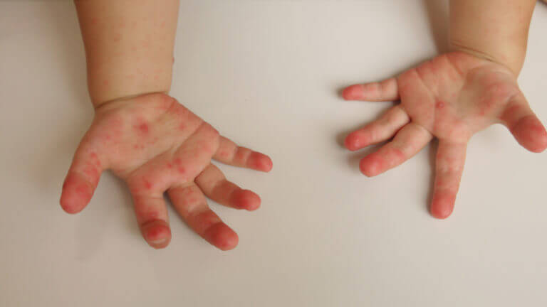 A baby hands with rashes due to pediatric atopic dermatitis.