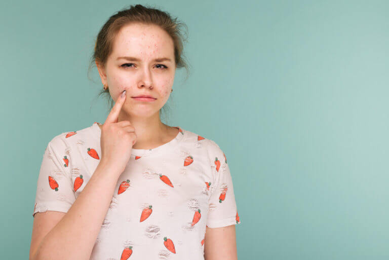 Image of teen girl touching her face and looking for acne.