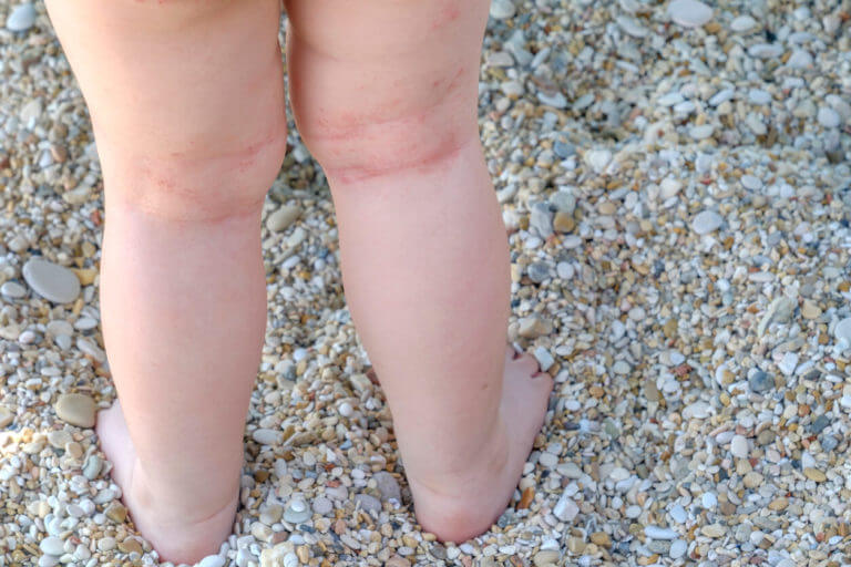 Close-up of a newborn’s legs showing signs of eczema, with visible skin irritation and symptoms of atopic dermatitis.