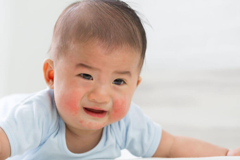 Skin rashes in a crying baby with eczema.